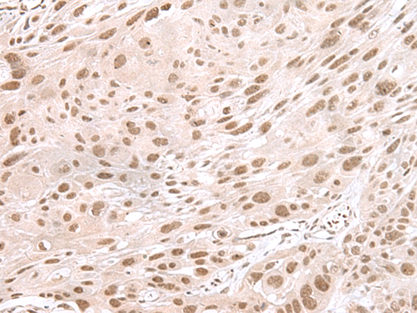 Immunohistochemistry of paraffin-embedded Human esophagus cancer tissue  using MAGOHB Polyclonal Antibody at dilution of 1:60(×200)