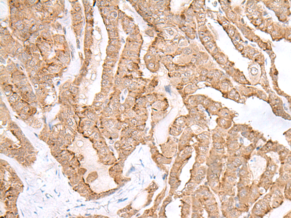 Immunohistochemistry of paraffin-embedded Human thyroid cancer tissue  using MAGOHB Polyclonal Antibody at dilution of 1:60(×200)