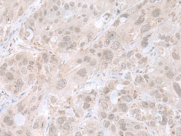 Immunohistochemistry of paraffin-embedded Human esophagus cancer tissue  using THAP12 Polyclonal Antibody at dilution of 1:45(×200)