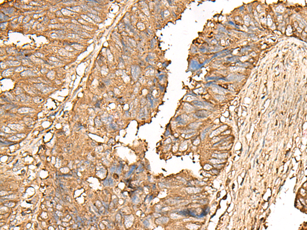 Immunohistochemistry of paraffin-embedded Human colorectal cancer tissue  using UBE2A Polyclonal Antibody at dilution of 1:55(×200)