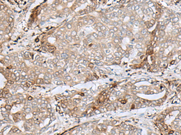 Immunohistochemistry of paraffin-embedded Human liver cancer tissue  using MRM1 Polyclonal Antibody at dilution of 1:85(×200)