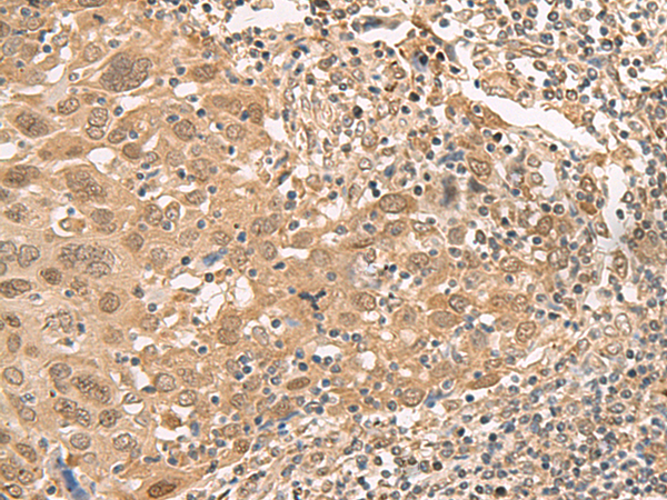 Immunohistochemistry of paraffin-embedded Human cervical cancer tissue  using ISCU Polyclonal Antibody at dilution of 1:45(×200)