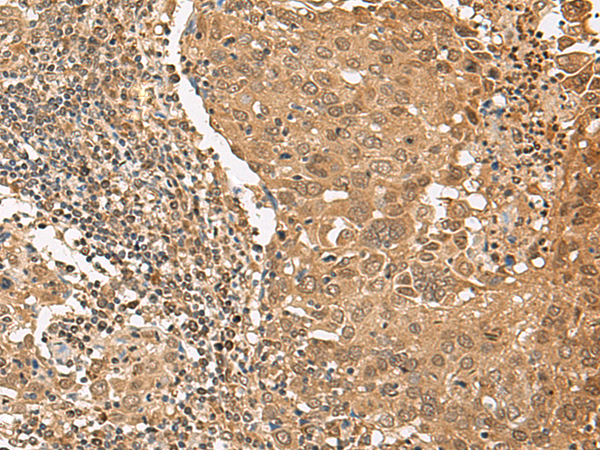 Immunohistochemistry of paraffin-embedded Human cervical cancer tissue  using TIPRL Polyclonal Antibody at dilution of 1:65(×200)