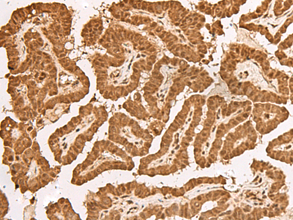 Immunohistochemistry of paraffin-embedded Human thyroid cancer tissue  using TIPRL Polyclonal Antibody at dilution of 1:65(×200)