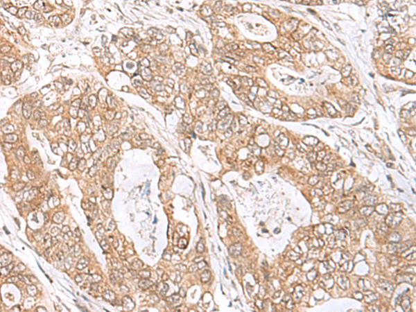 Immunohistochemistry of paraffin-embedded Human gastric cancer tissue  using SEC11A Polyclonal Antibody at dilution of 1:45(×200)