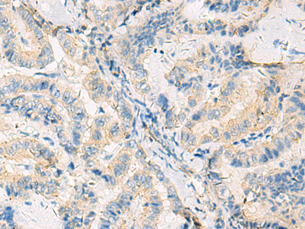 Immunohistochemistry of paraffin-embedded Human thyroid cancer tissue  using SYNGR1 Polyclonal Antibody at dilution of 1:50(×200)