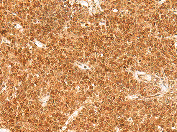 Immunohistochemistry of paraffin-embedded Human ovarian cancer tissue  using TOR1A Polyclonal Antibody at dilution of 1:30(×200)