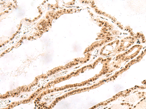 Immunohistochemistry of paraffin-embedded Human thyroid cancer tissue  using TOR1A Polyclonal Antibody at dilution of 1:30(×200)