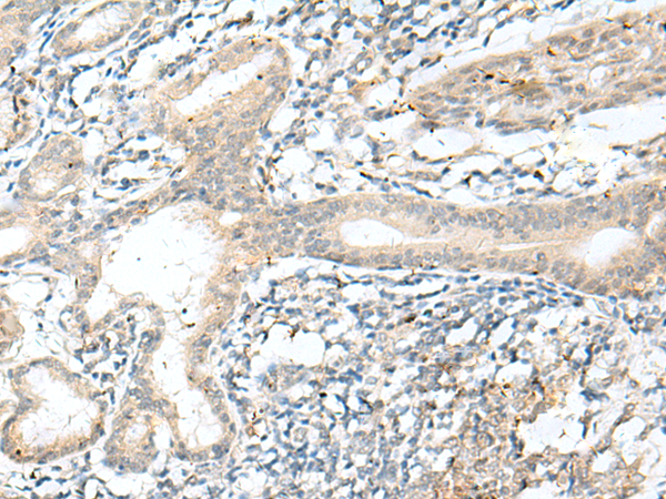 Immunohistochemistry of paraffin-embedded Human esophagus cancer tissue  using NXNL1 Polyclonal Antibody at dilution of 1:45(×200)