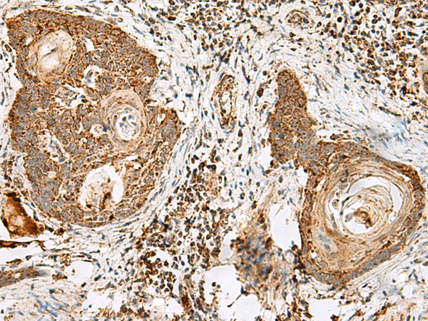 Immunohistochemistry of paraffin-embedded Human esophagus cancer tissue  using CD48 Polyclonal Antibody at dilution of 1:40(×200)