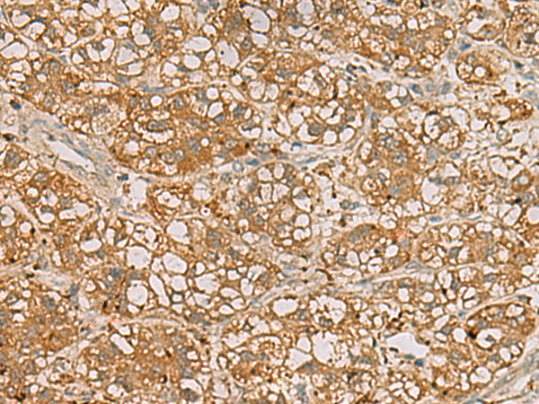 Immunohistochemistry of paraffin-embedded Human liver cancer tissue  using QDPR Polyclonal Antibody at dilution of 1:70(×200)