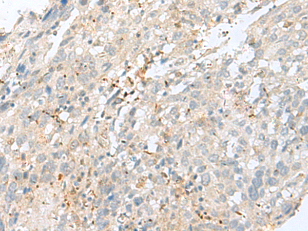 Immunohistochemistry of paraffin-embedded Human cervical cancer tissue  using TPMT Polyclonal Antibody at dilution of 1:60(×200)