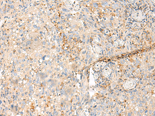 Immunohistochemistry of paraffin-embedded Human cervical cancer tissue  using MDFI Polyclonal Antibody at dilution of 1:50(×200)