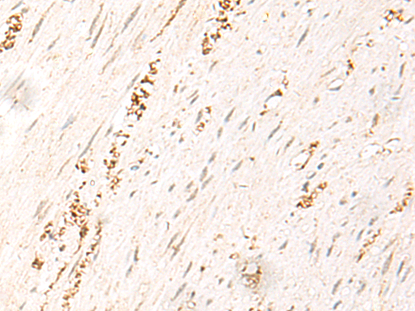 Immunohistochemistry of paraffin-embedded Human colorectal cancer tissue  using MDFI Polyclonal Antibody at dilution of 1:50(×200)