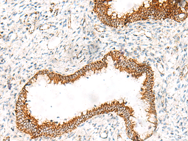 Immunohistochemistry of paraffin-embedded Human cervical cancer tissue  using ORC4 Polyclonal Antibody at dilution of 1:70(×200)