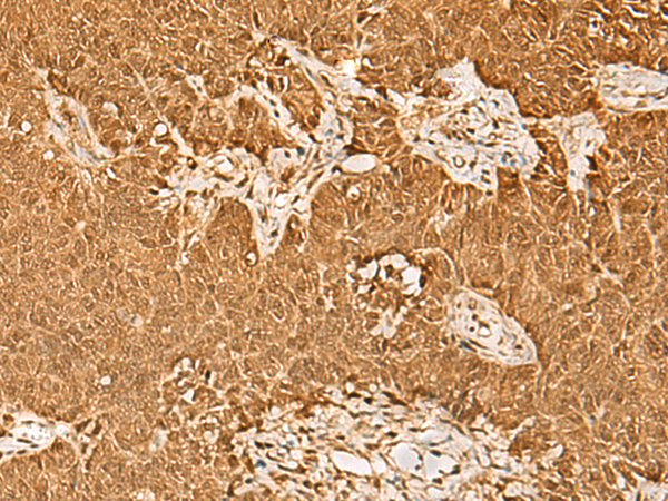Immunohistochemistry of paraffin-embedded Human ovarian cancer tissue  using PSMA3 Polyclonal Antibody at dilution of 1:30(×200)
