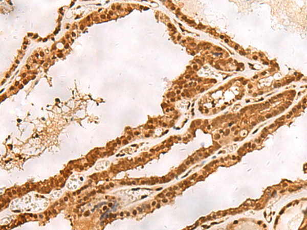 Immunohistochemistry of paraffin-embedded Human thyroid cancer tissue  using PSMA3 Polyclonal Antibody at dilution of 1:30(×200)