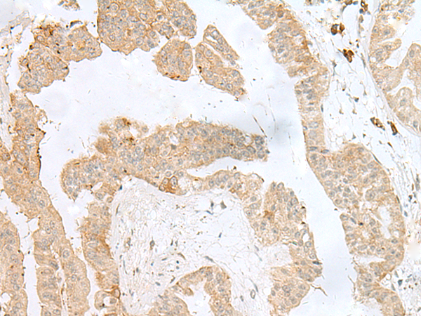 Immunohistochemistry of paraffin-embedded Human liver cancer tissue  using PSMA4 Polyclonal Antibody at dilution of 1:50(×200)