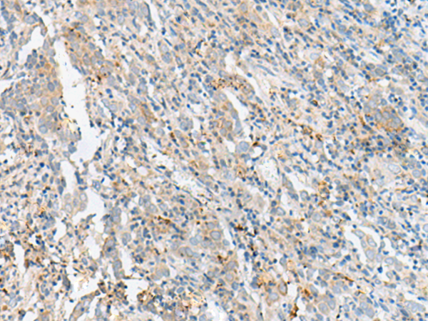 Immunohistochemistry of paraffin-embedded Human cervical cancer tissue  using CTRB1 Polyclonal Antibody at dilution of 1:60(×200)