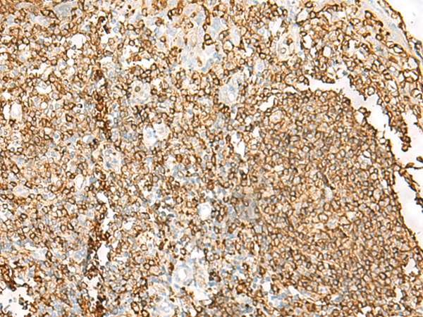 Immunohistochemistry of paraffin-embedded Human tonsil tissue  using HLA-DRB1 Polyclonal Antibody at dilution of 1:65(×200)