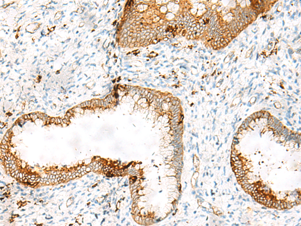 Immunohistochemistry of paraffin-embedded Human cervical cancer tissue  using HLA-DRB1 Polyclonal Antibody at dilution of 1:65(×200)