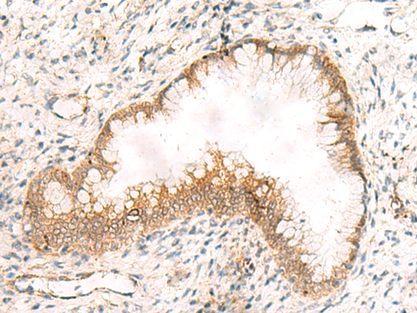 Immunohistochemistry of paraffin-embedded Human cervical cancer tissue  using ZNF397 Polyclonal Antibody at dilution of 1:45(×200)