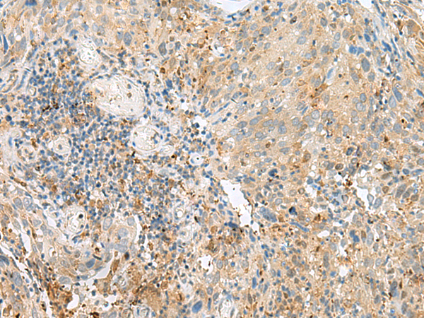 Immunohistochemistry of paraffin-embedded Human cervical cancer tissue  using CNPY3 Polyclonal Antibody at dilution of 1:55(×200)