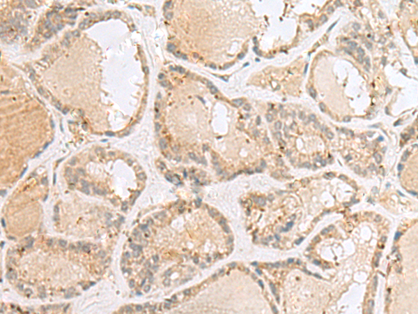 Immunohistochemistry of paraffin-embedded Human thyroid cancer tissue  using CNPY3 Polyclonal Antibody at dilution of 1:55(×200)