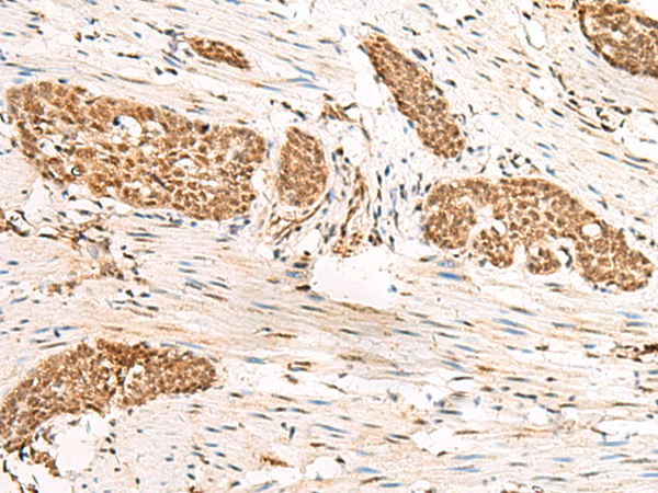 Immunohistochemistry of paraffin-embedded Human esophagus cancer tissue  using HUS1 Polyclonal Antibody at dilution of 1:45(×200)
