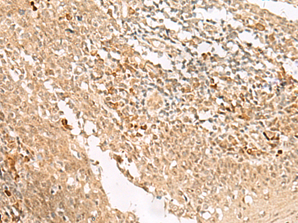 Immunohistochemistry of paraffin-embedded Human tonsil tissue  using HUS1 Polyclonal Antibody at dilution of 1:45(×200)