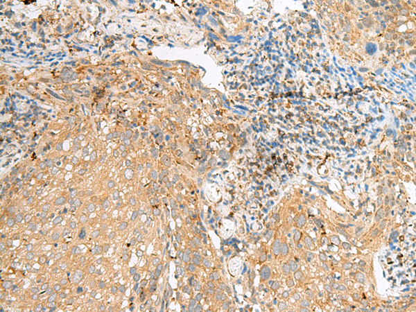 Immunohistochemistry of paraffin-embedded Human cervical cancer tissue  using COPE Polyclonal Antibody at dilution of 1:50(×200)