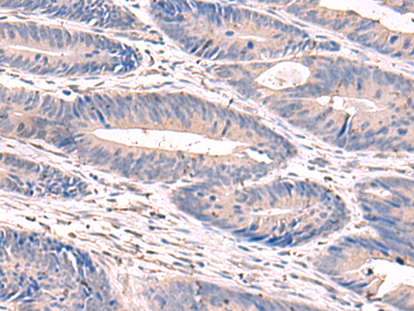 Immunohistochemistry of paraffin-embedded Human colorectal cancer tissue  using GKAP1 Polyclonal Antibody at dilution of 1:100(×200)