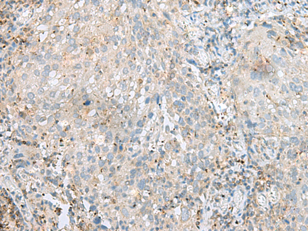 Immunohistochemistry of paraffin-embedded Human cervical cancer tissue  using SEPT1 Polyclonal Antibody at dilution of 1:60(×200)