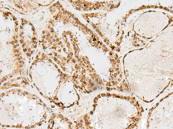 Immunohistochemistry of paraffin-embedded Human thyroid cancer tissue  using SNAPC1 Polyclonal Antibody at dilution of 1:60(×200)