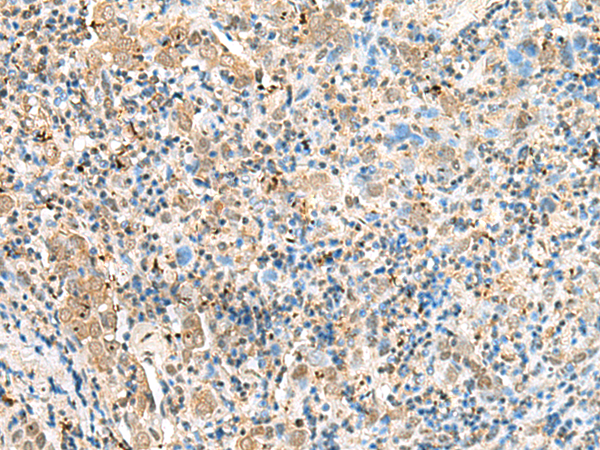 Immunohistochemistry of paraffin-embedded Human cervical cancer tissue  using SNAPC1 Polyclonal Antibody at dilution of 1:60(×200)