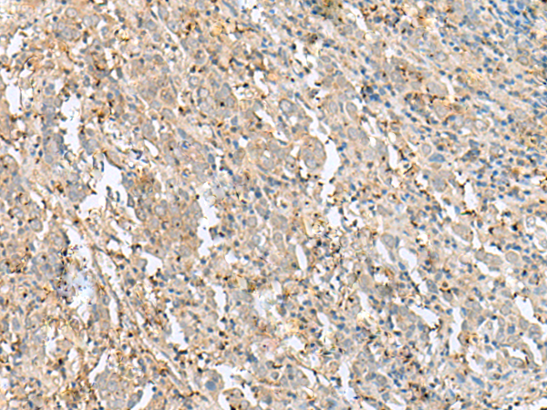 Immunohistochemistry of paraffin-embedded Human cervical cancer tissue  using FLOT2 Polyclonal Antibody at dilution of 1:50(×200)