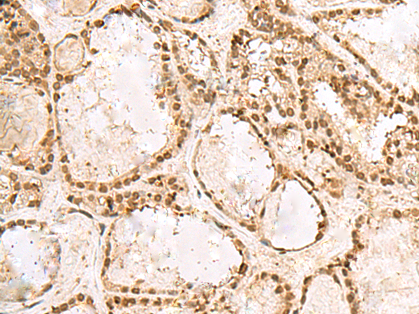 Immunohistochemistry of paraffin-embedded Human thyroid cancer tissue  using KRR1 Polyclonal Antibody at dilution of 1:50(×200)