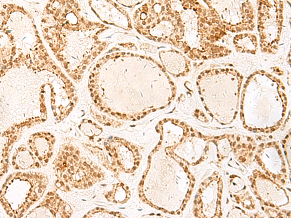 Immunohistochemistry of paraffin-embedded Human thyroid cancer tissue  using PSPC1 Polyclonal Antibody at dilution of 1:25(×200)