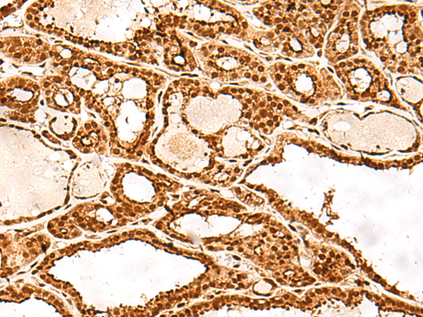 Immunohistochemistry of paraffin-embedded Human thyroid cancer tissue  using ADRM1 Polyclonal Antibody at dilution of 1:30(×200)