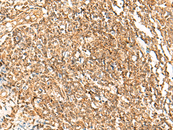 Immunohistochemistry of paraffin-embedded Human tonsil tissue  using POLH Polyclonal Antibody at dilution of 1:45(×200)