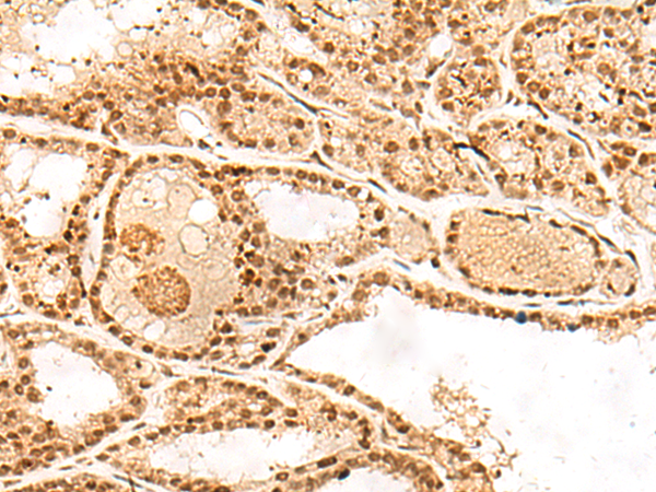 Immunohistochemistry of paraffin-embedded Human thyroid cancer tissue  using POLH Polyclonal Antibody at dilution of 1:45(×200)