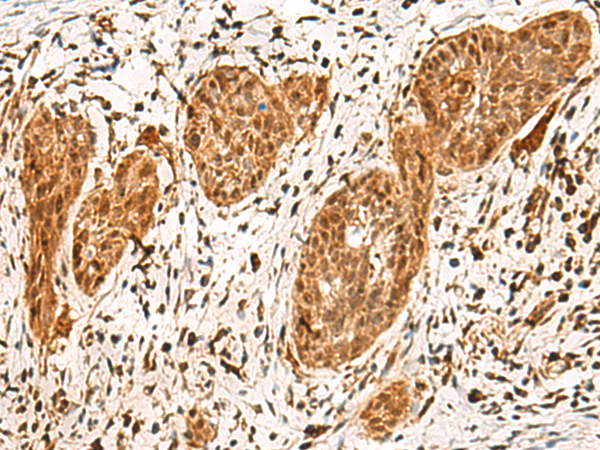 Immunohistochemistry of paraffin-embedded Human esophagus cancer tissue  using POLR1E Polyclonal Antibody at dilution of 1:40(×200)