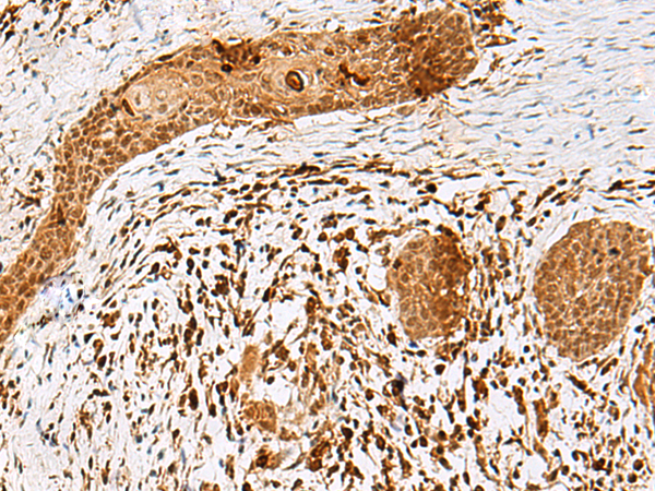 Immunohistochemistry of paraffin-embedded Human esophagus cancer tissue  using SCRN2 Polyclonal Antibody at dilution of 1:50(×200)
