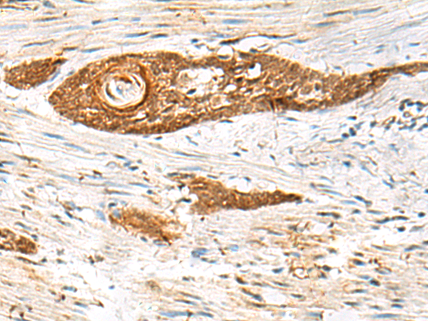Immunohistochemistry of paraffin-embedded Human esophagus cancer tissue  using GPSM1 Polyclonal Antibody at dilution of 1:85(×200)