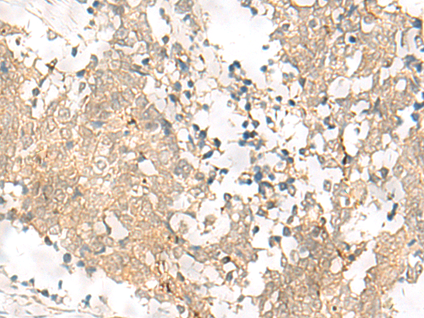 Immunohistochemistry of paraffin-embedded Human lung cancer tissue  using GPSM1 Polyclonal Antibody at dilution of 1:85(×200)