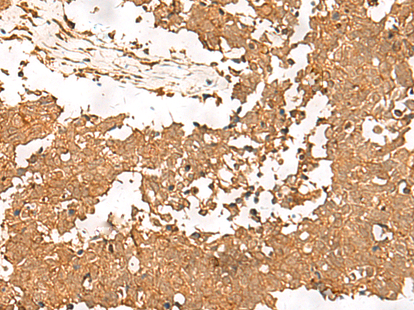 Immunohistochemistry of paraffin-embedded Human lung cancer tissue  using SMOC1 Polyclonal Antibody at dilution of 1:35(×200)