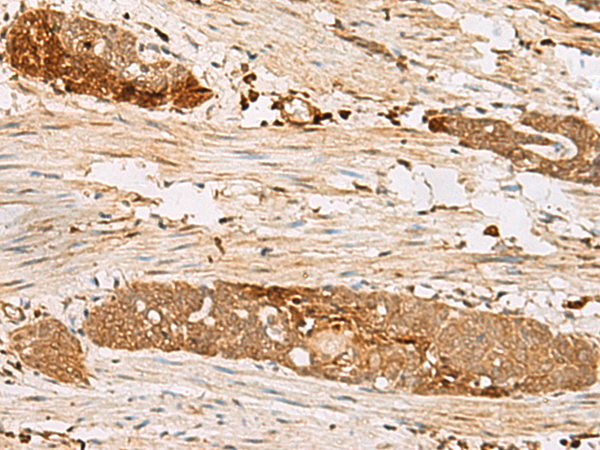 Immunohistochemistry of paraffin-embedded Human esophagus cancer tissue  using PSMD12 Polyclonal Antibody at dilution of 1:50(×200)