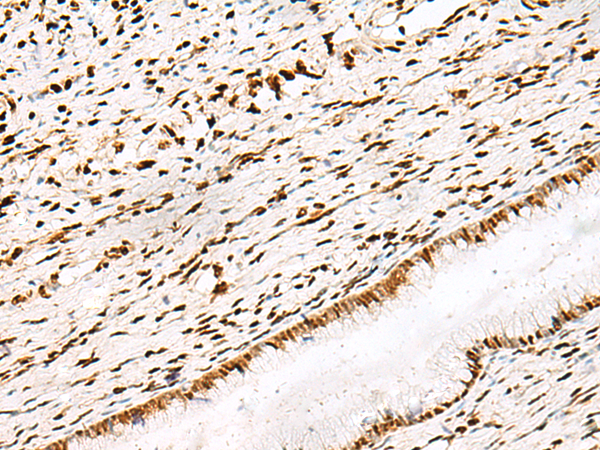 Immunohistochemistry of paraffin-embedded Human cervical cancer tissue  using DNPEP Polyclonal Antibody at dilution of 1:30(×200)