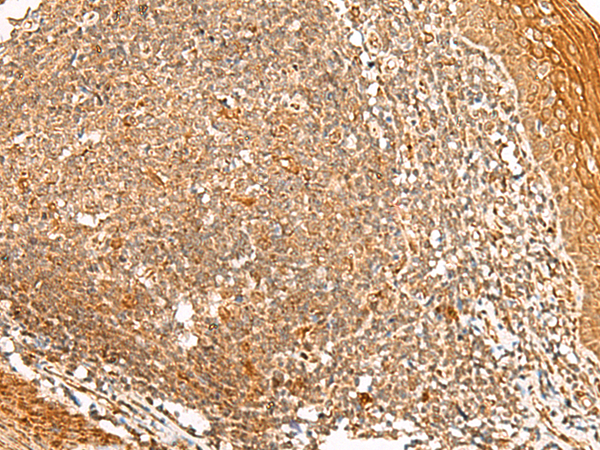 Immunohistochemistry of paraffin-embedded Human tonsil tissue  using PPOX Polyclonal Antibody at dilution of 1:45(×200)