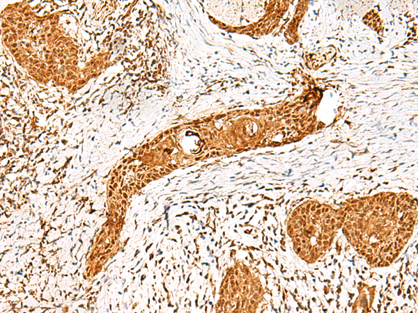 Immunohistochemistry of paraffin-embedded Human esophagus cancer tissue  using PPOX Polyclonal Antibody at dilution of 1:45(×200)